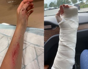 Ebba Nilsson's arm got hurt in a stable accident