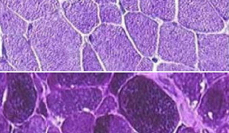 Muscle biopsy showing normal glycogen storage (top) and from a horse with a GYS1 gene mutation (bottom). The dark areas from the afflicted tissue sample show the excess glycogen stored in the muscle cells :: Photo © www.pssmawareness.com)