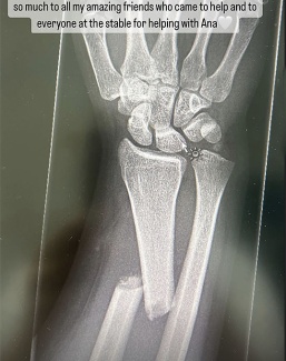 Olivia Vliek fractured her arm and wrist in a car accident. Get well soon!
