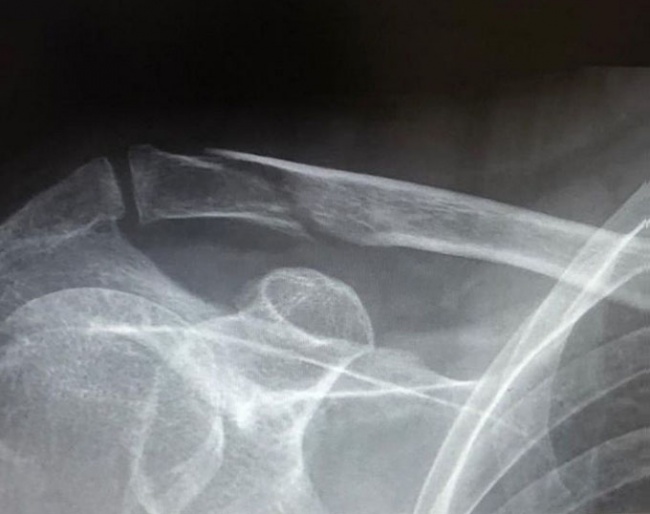 Anky van Grunsven's fractured collar bone
