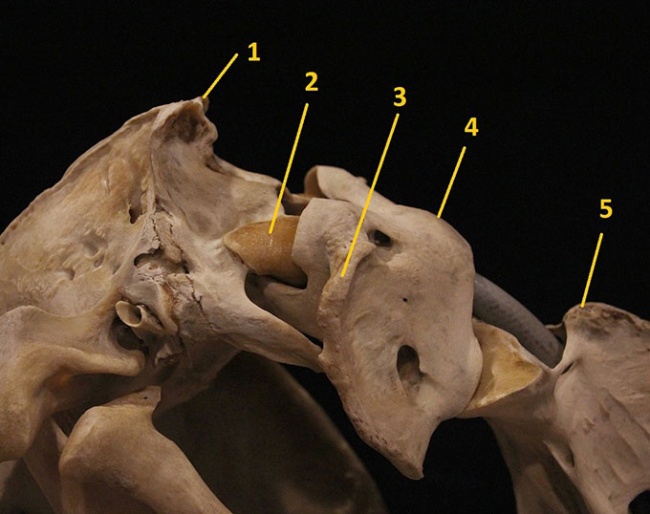1. Nuchal crest, 2. Occipital condyle, 3. Wing of Atlas, 4. Atlas (C1), 5. Axis (C2)