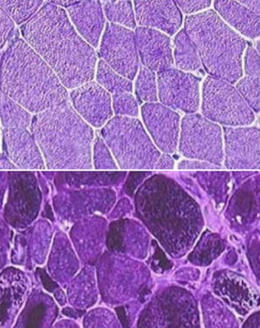 Muscle biopsy showing normal glycogen storage (top) and from a horse with a GYS1 gene mutation (bottom). The dark areas from the afflicted tissue sample show the excess glycogen stored in the muscle cells :: Photo © www.pssmawareness.com)